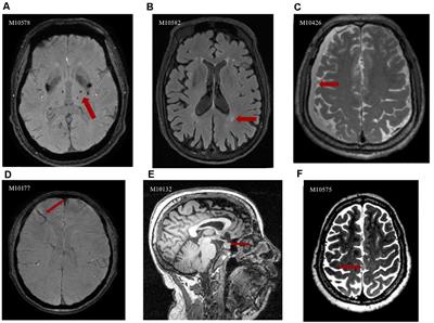 Incidental Brain Magnetic Resonance Imaging Findings and the Cognitive and Motor Performance in the Elderly: The Shanghai Changfeng Study